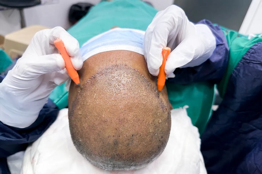 Will Hair Transplant Work on Curly or Afro Hair Types?